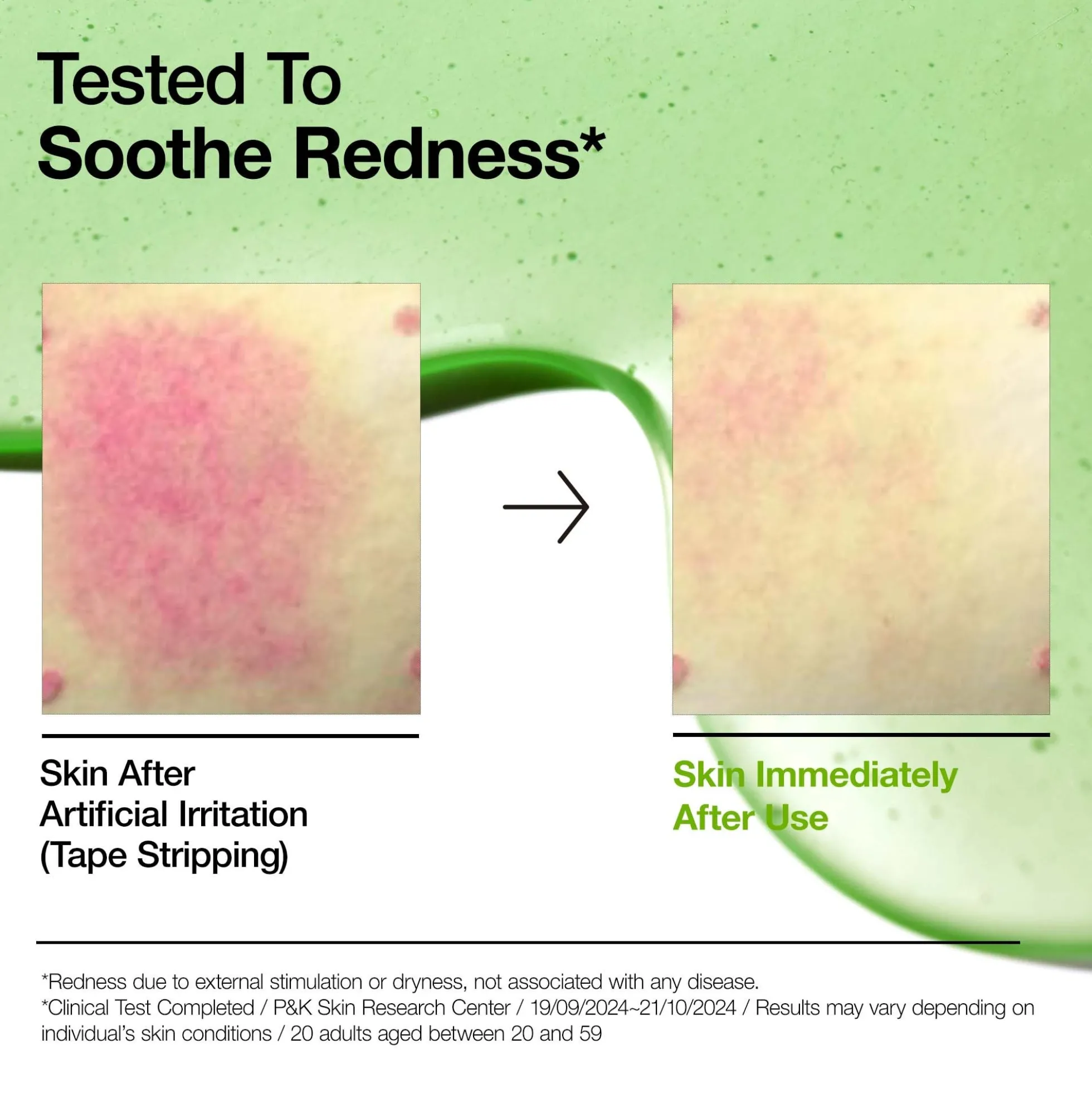Anua Azelaic Acid 10 Hyaluron Redness Soothing Serum 30ml