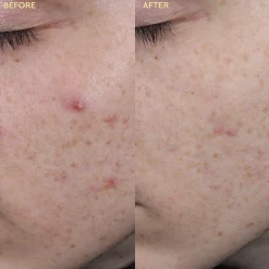 BYOMA Blemish Clearing Paste 15ml