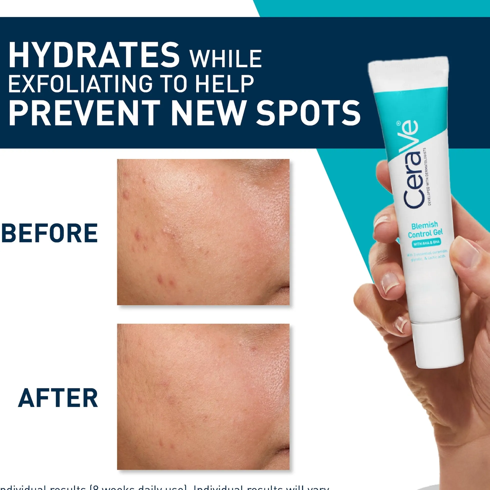 CeraVe Blemish Control Gel Moisturiser with 2% Salicylic Acid & Niacinamide for Blemish-Prone Skin 40ml