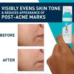 CeraVe Resurfacing Retinol Serum with Ceramides and Niacinamide for Blemish-Prone Skin 30ml