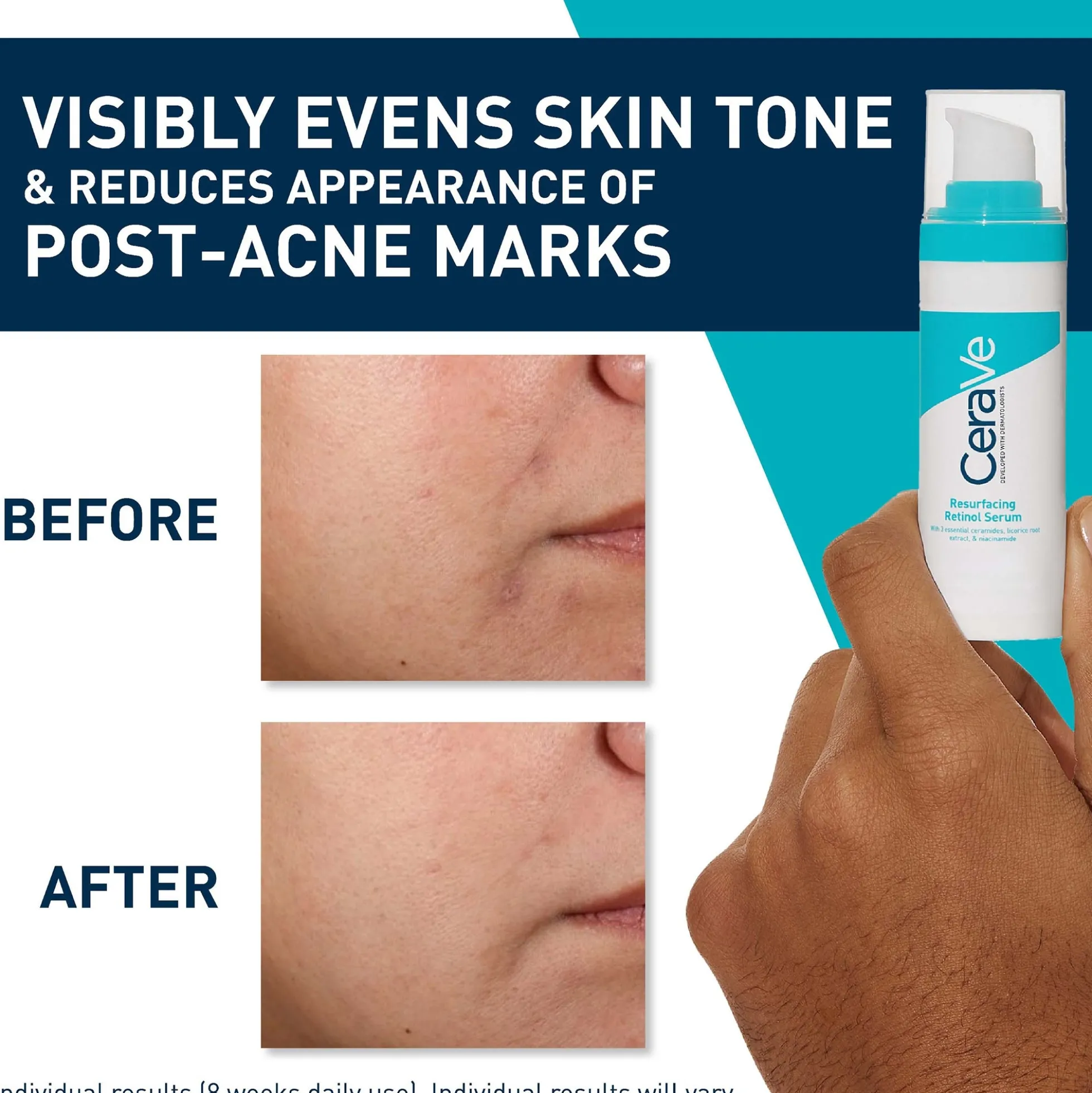 CeraVe Resurfacing Retinol Serum with Ceramides and Niacinamide for Blemish-Prone Skin 30ml