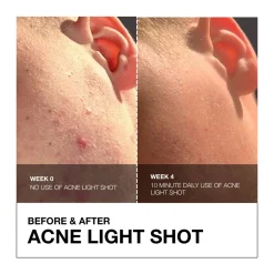 FaceGym Acne Light Shot Device