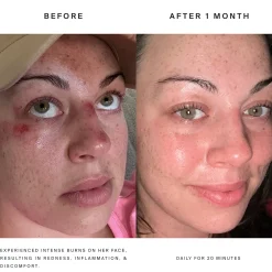 HigherDOSE Red Light Face Mask
