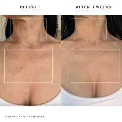 HigherDOSE Red Light Neck Enhancer