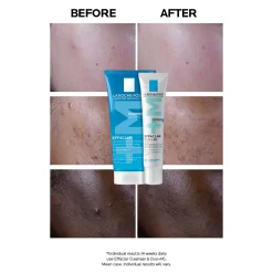 La Roche-Posay Effaclar Duo+M Anti-Blemish Corrective Gel Moisturiser for Oily, Blemish-Prone Skin 40ml