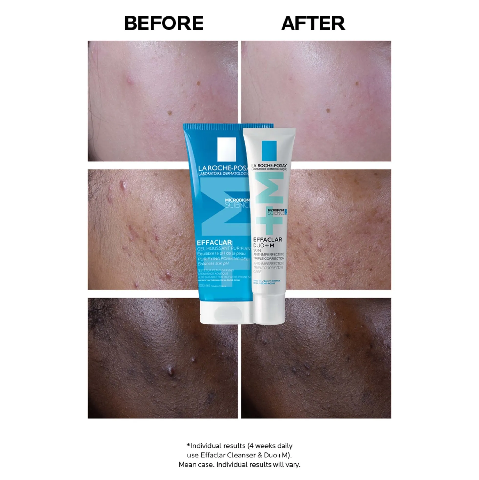 La Roche-Posay Effaclar Duo+M Anti-Blemish Corrective Gel Moisturiser for Oily, Blemish-Prone Skin 40ml