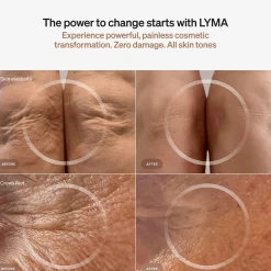 LYMA Laser Starter Kit
