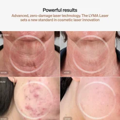 LYMA Laser Starter Kit