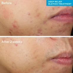 Murad Deep Relief Blemish Treatment 30ml
