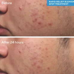 Murad Rapid Relief Spot Treatment 15ml