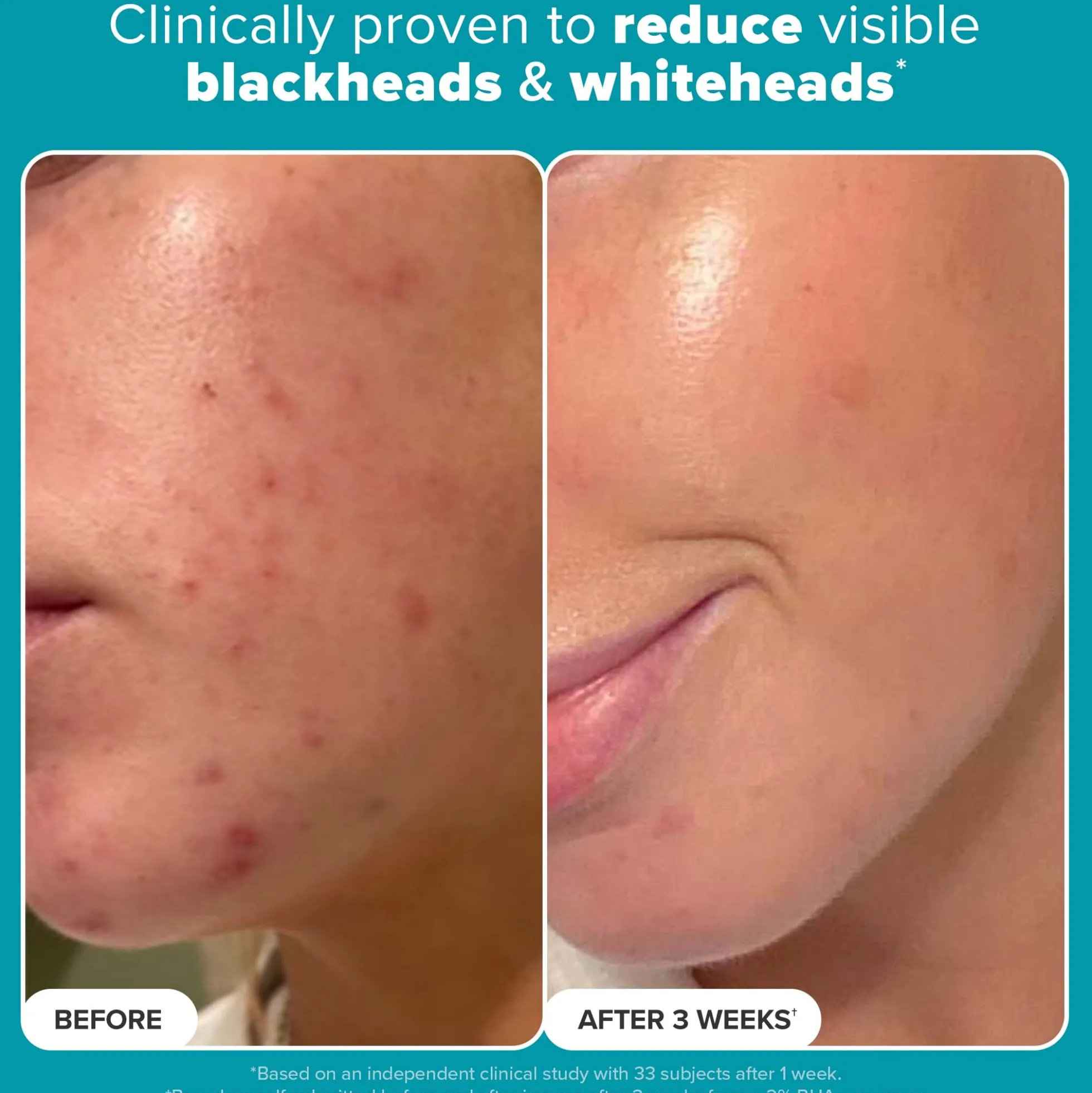 Paulas Choice Skin Perfecting 2% BHA Exfoliating Toner 30ml