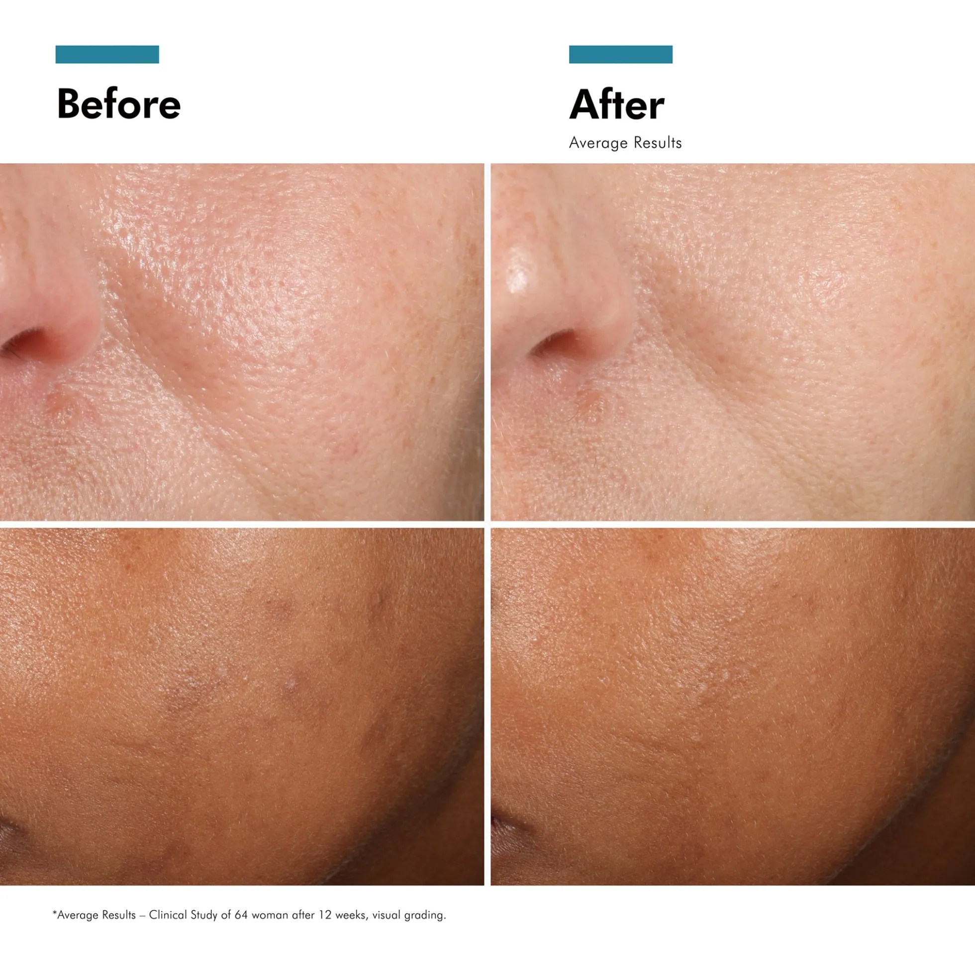 SkinCeuticals Phloretin CF Antioxidant Serum for Normal, Combination, Discolouration-Prone Skin Types