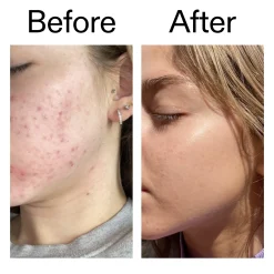 The INKEY List Beta Hydroxy Acid Serum 30ml