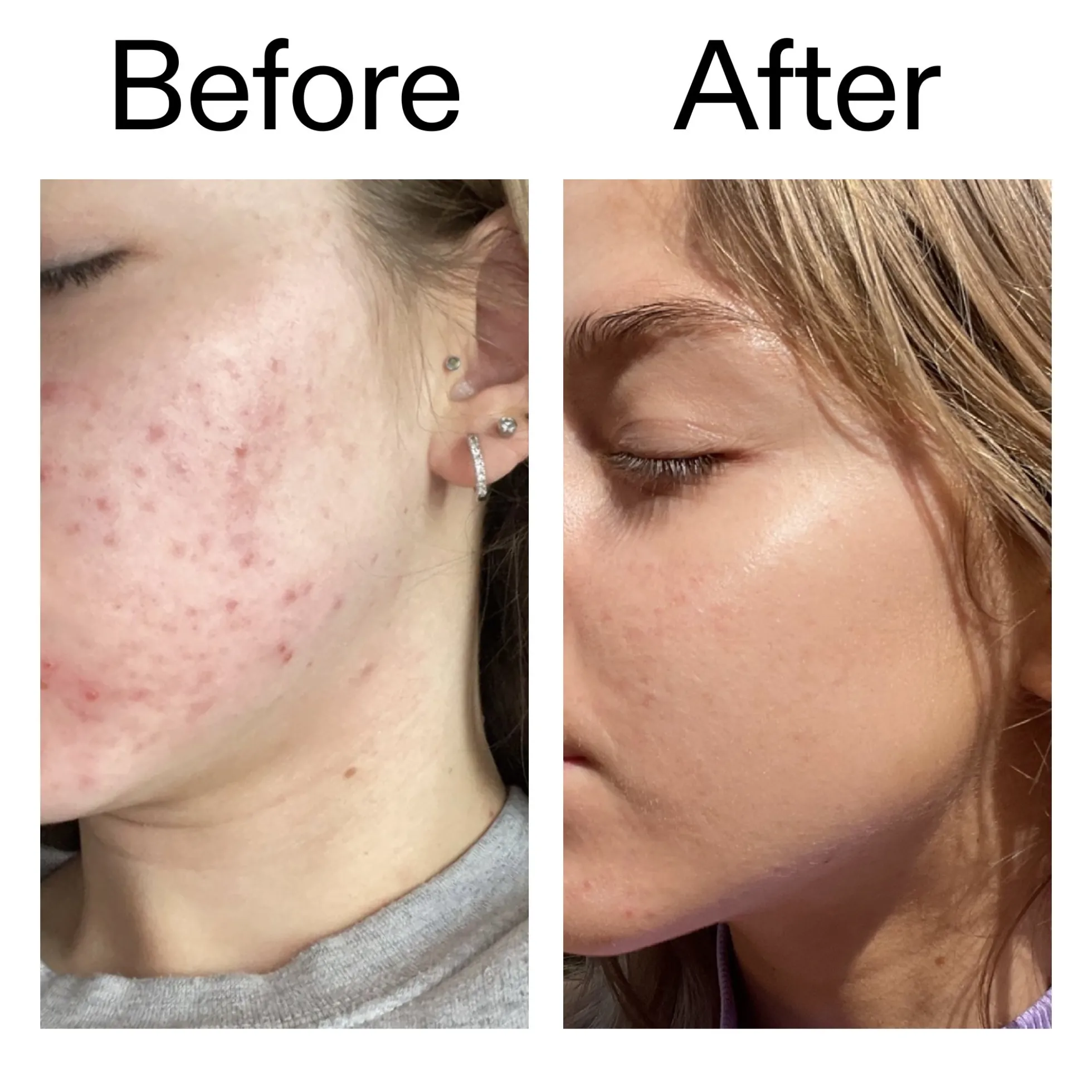 The INKEY List Beta Hydroxy Acid Serum 30ml