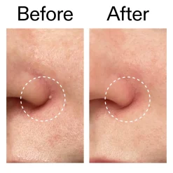 The INKEY List Hydrocolloid Invisible Pimple Patches (22 patches)