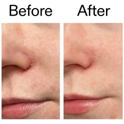 The INKEY List Hydrocolloid Invisible Pimple Patches Supersize 44 units