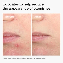 The Ordinary Salicylic Acid 2% Solution 30ml