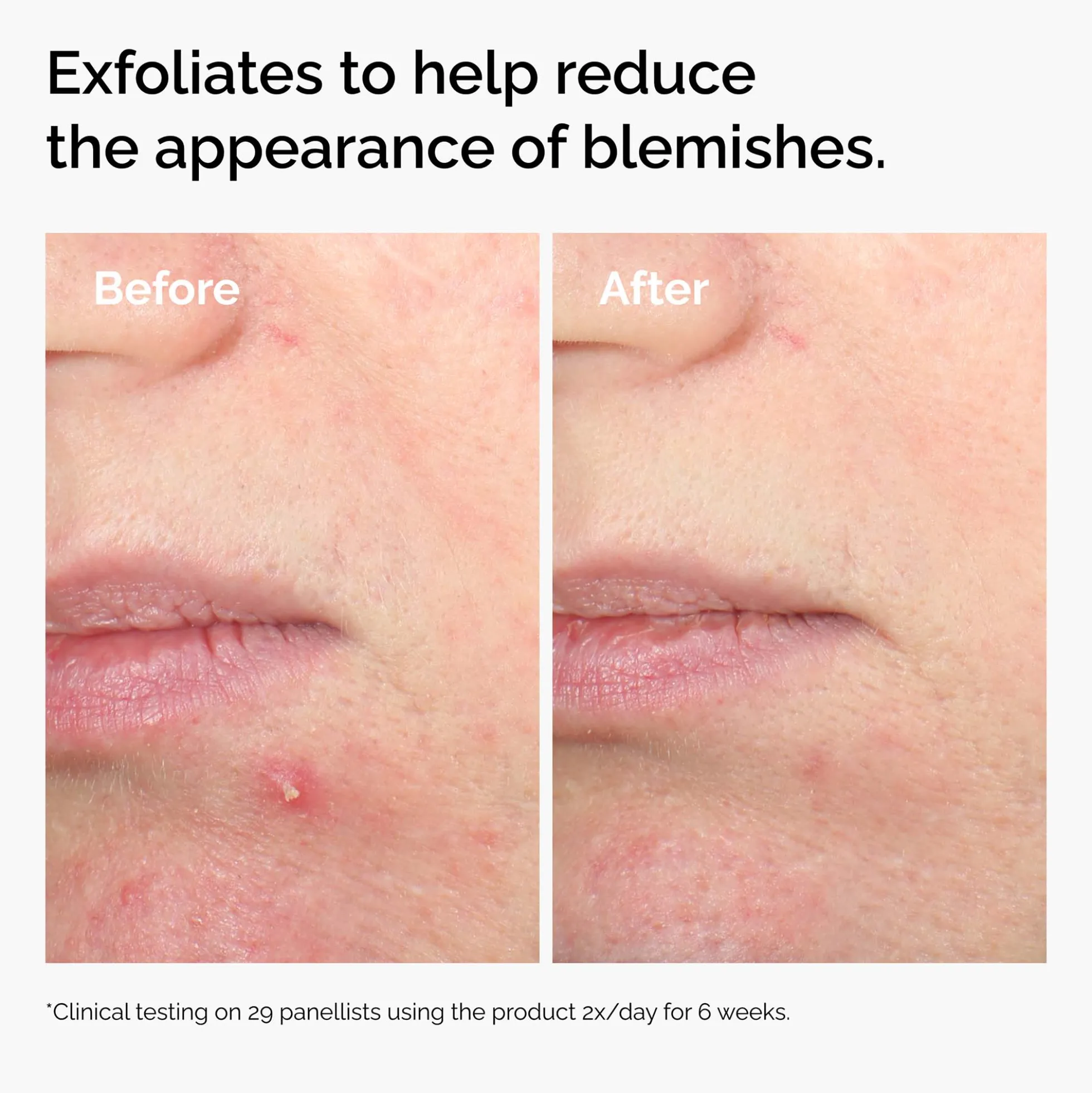 The Ordinary Salicylic Acid 2% Solution 30ml