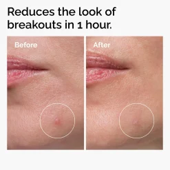The Ordinary's The Target & Treat Set for Blemish-Prone Skin